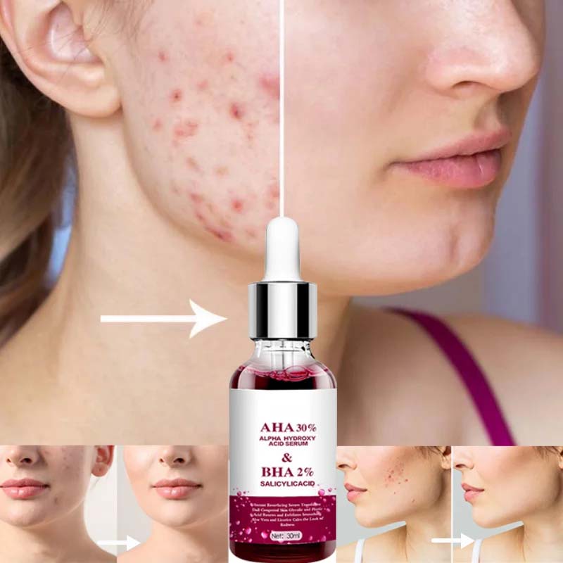 SERUM ANTI-ACNÉ / ANTI-MANCHAS